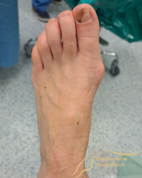 preoperative photo of bunion